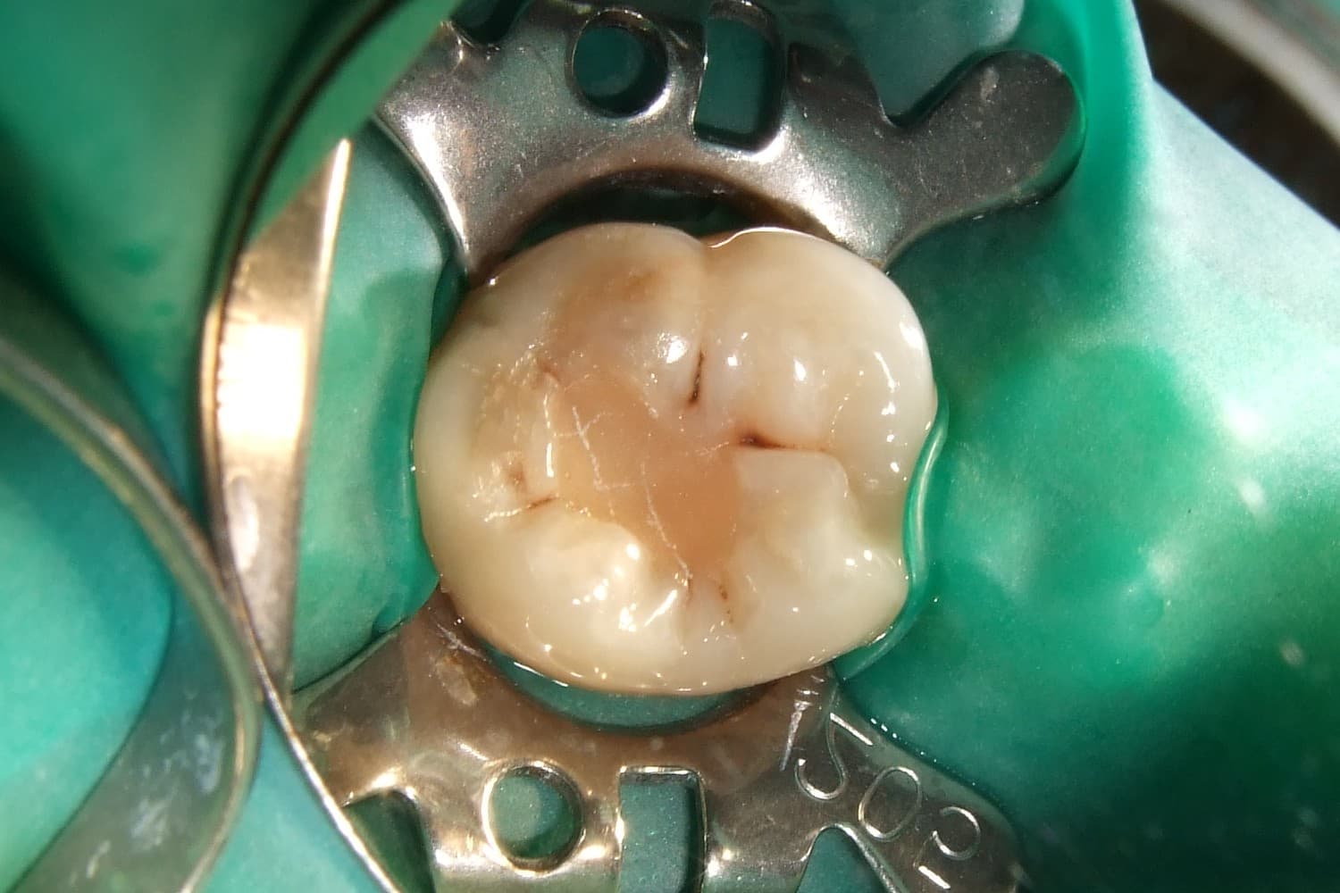 Gercek posterior agiz ici fotograf ornegi